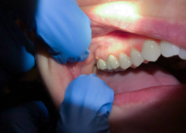 Best Emergency Tooth Extraction  in Lake Don Pedro, CA